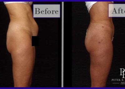 Liposuction Before and After