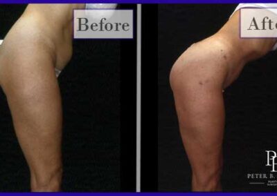 Liposuction Before and After