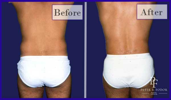 Liposuction Before and After Photos