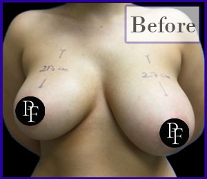 Liposuction Only Breast Reduction and Asymmetry correction before and after