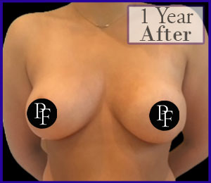 Liposuction Only Breast Reduction and Asymmetry correction before and after