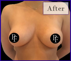 Scarless Breast Reduction