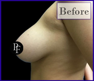 Liposuction Only Breast Reduction and Asymmetry correction before and after