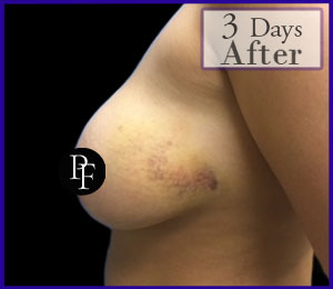 Liposuction Only Breast Reduction and Asymmetry correction before and after