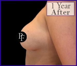 Liposuction Only Breast Reduction and Asymmetry correction before and after