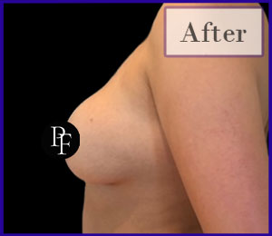 Scarless Breast Reduction