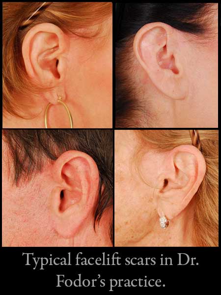 Facelift Scars by Dr. Peter B. Fodor - Facelift Surgeon Los Angeles