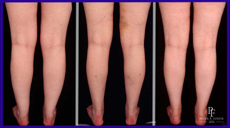 Liposuction before and after of the legs