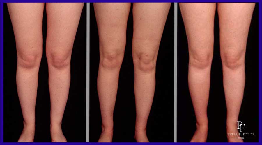 Liposuction before and after of the legs