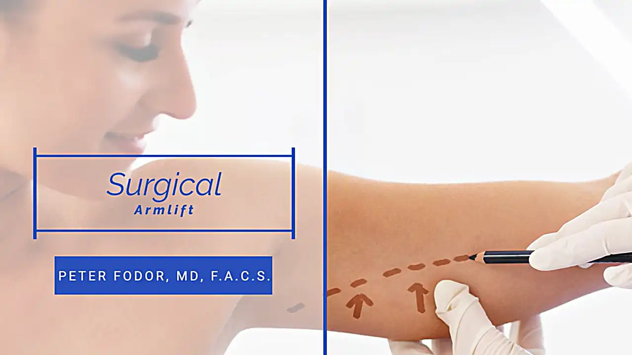 In this video, Dr. Fodor discusses arm lift surgery options.