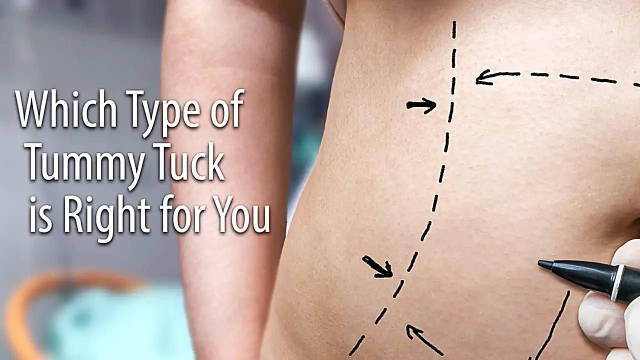 Which type of tummy tuck is right for me? In this video, Dr. Fodor discusses the different types of tummy tuck.